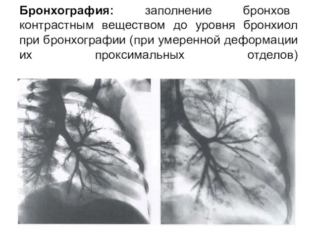 Бронхография: заполнение бронхов контрастным веществом до уровня бронхиол при бронхографии (при умеренной деформации их проксимальных отделов)