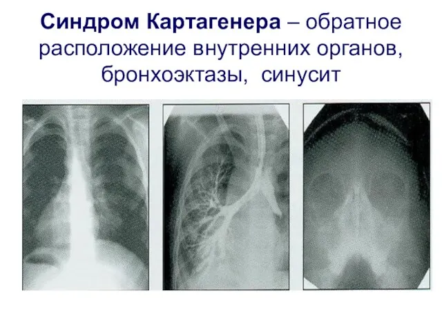 Синдром Картагенера – обратное расположение внутренних органов, бронхоэктазы, синусит