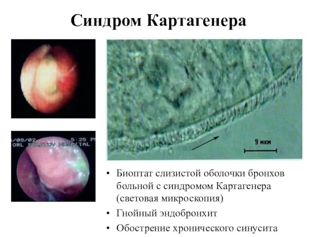 Синдром Картагенера Биоптат слизистой оболочки бронхов больной с синдромом Картагенера