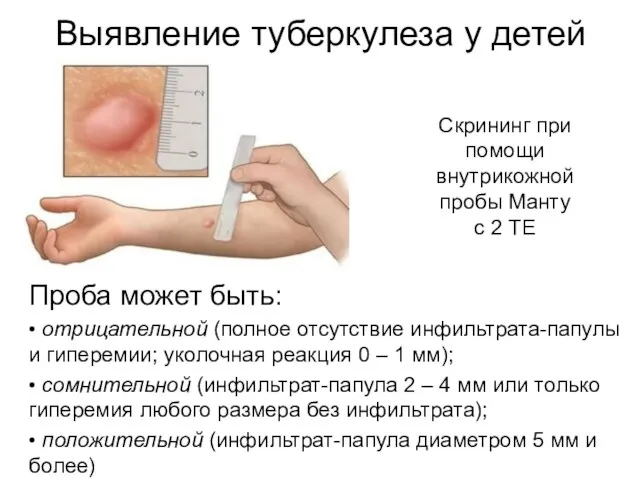 Выявление туберкулеза у детей Проба может быть: • отрицательной (полное