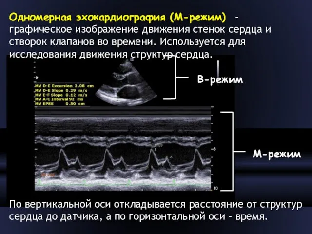 Одномерная эхокардиография (М-режим) - графическое изображение движения стенок сердца и