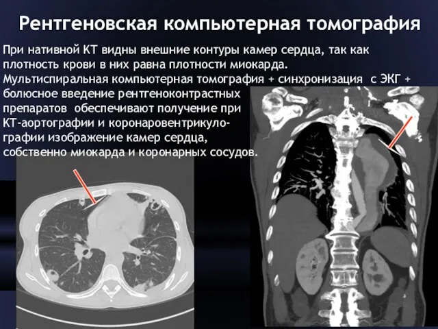 Рентгеновская компьютерная томография При нативной KT видны внешние контуры камер