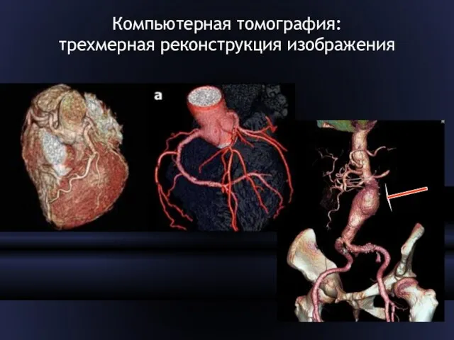 Компьютерная томография: трехмерная реконструкция изображения