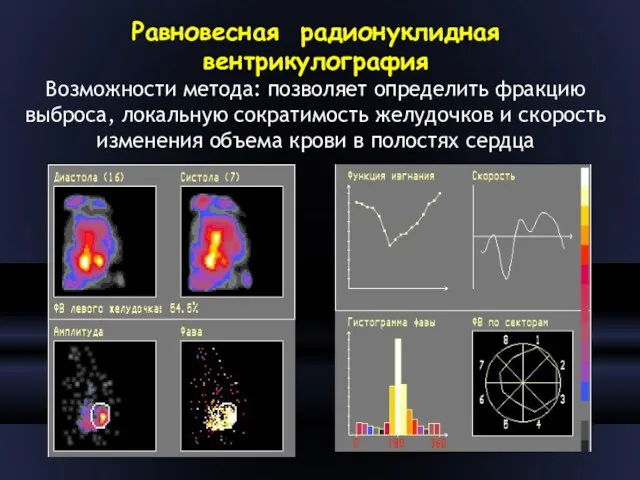 Равновесная радионуклидная вентрикулография Возможности метода: позволяет определить фракцию выброса, локальную