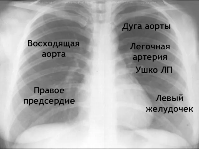 Правое предсердие Восходящая аорта Дуга аорты Легочная артерия Ушко ЛП Левый желудочек