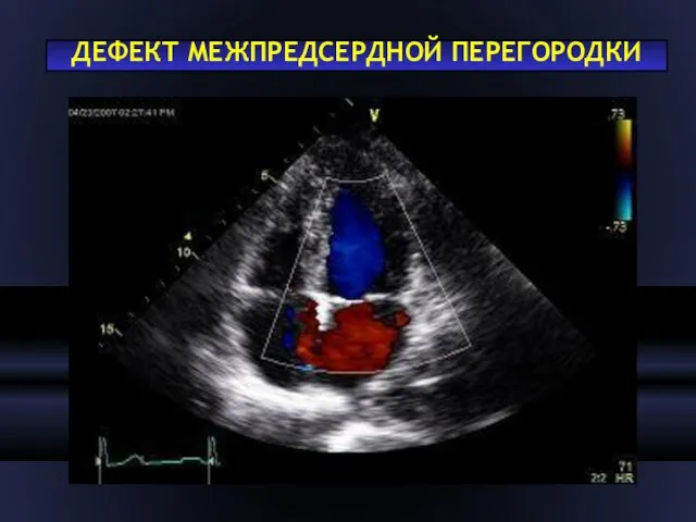 ДЕФЕКТ МЕЖПРЕДСЕРДНОЙ ПЕРЕГОРОДКИ