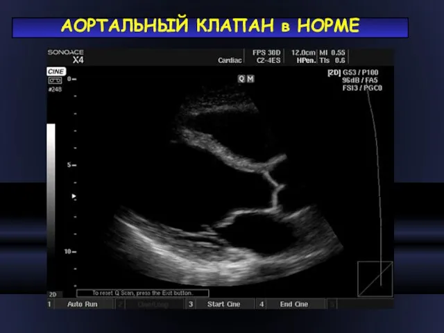 АОРТАЛЬНЫЙ КЛАПАН в НОРМЕ