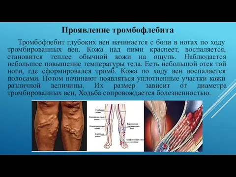 Проявление тромбофлебита Тромбофлебит глубоких вен начинается с боли в ногах