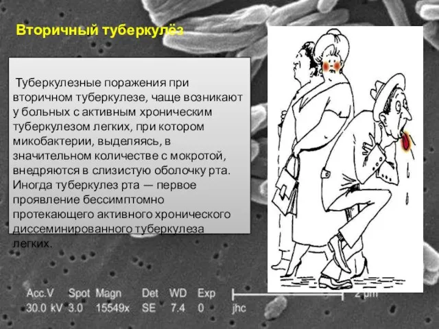 Вторичный туберкулёз Туберкулезные поражения при вторичном туберкулезе, чаще возникают у