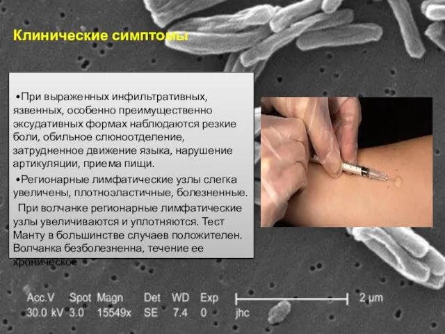 Клинические симптомы •При выраженных инфильтративных, язвенных, особенно преимущественно эксудативных формах