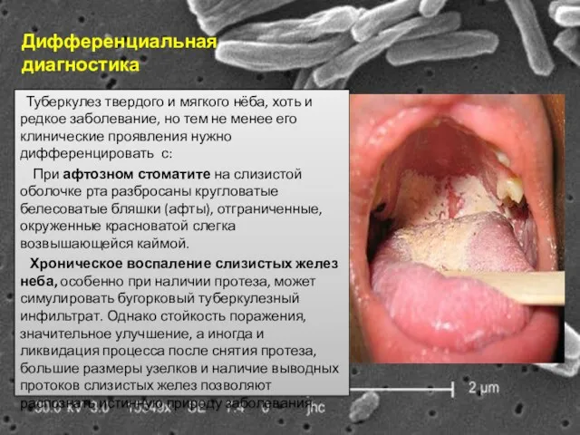 Туберкулез твердого и мягкого нёба, хоть и редкое заболевание, но