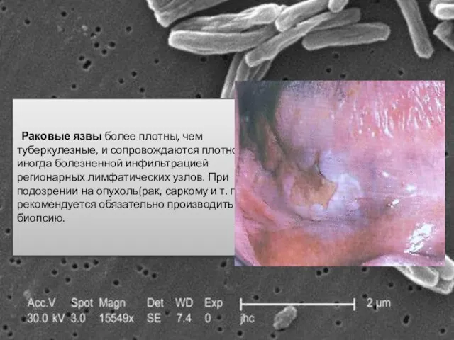 Раковые язвы более плотны, чем туберкулезные, и сопровождаются плотной, иногда