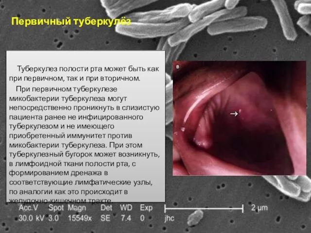 Первичный туберкулёз Туберкулез полости рта может быть как при первичном,