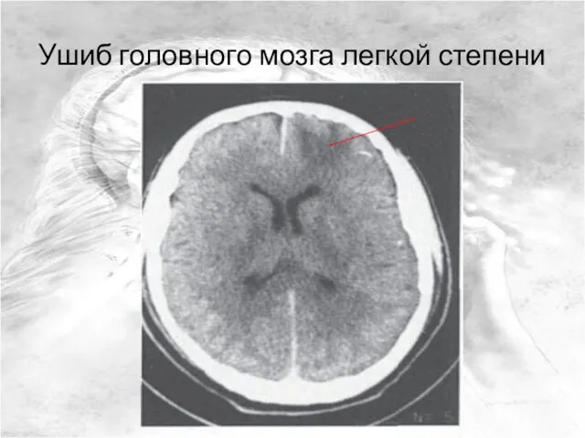 Ушиб головного мозга легкой степени