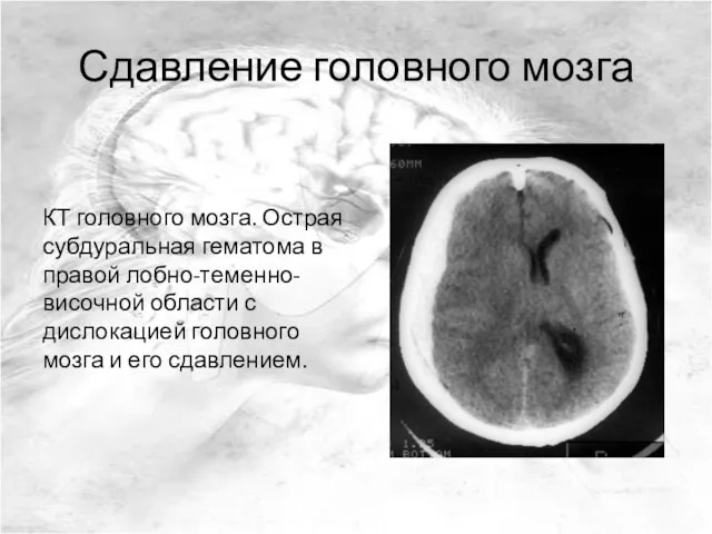 Сдавление головного мозга КТ головного мозга. Острая субдуральная гематома в