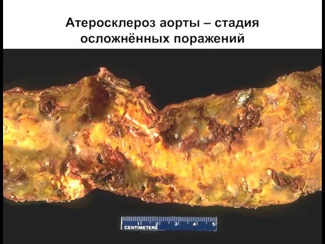 Атеросклероз аорты – стадия осложнённых поражений