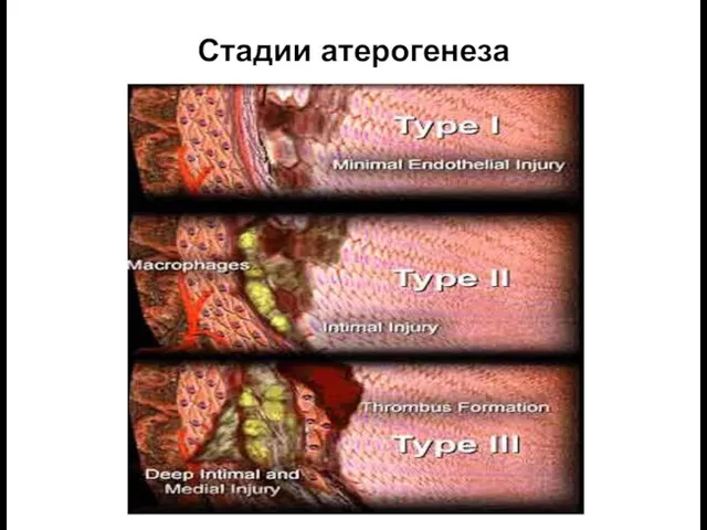 Стадии атерогенеза