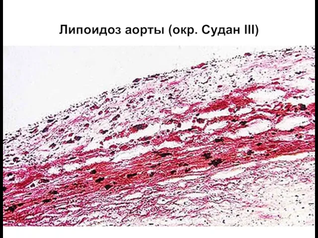 Липоидоз аорты (окр. Судан III)