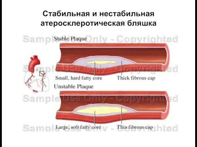 Стабильная и нестабильная атеросклеротическая бляшка