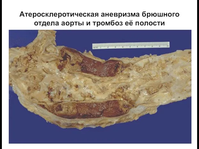 Атеросклеротическая аневризма брюшного отдела аорты и тромбоз её полости