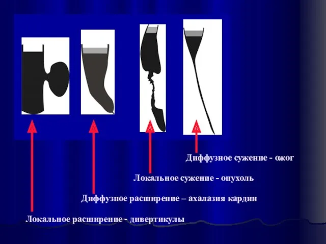 Локальное расширение - дивертикулы Локальное сужение - опухоль Диффузное расширение