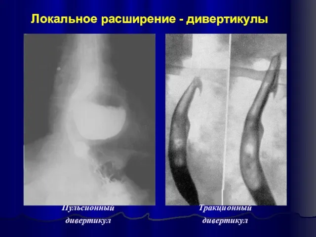 Пульсионный дивертикул Тракционный дивертикул Локальное расширение - дивертикулы