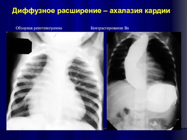 Обзорная рентгенограмма Контрастирование Ва Диффузное расширение – ахалазия кардии