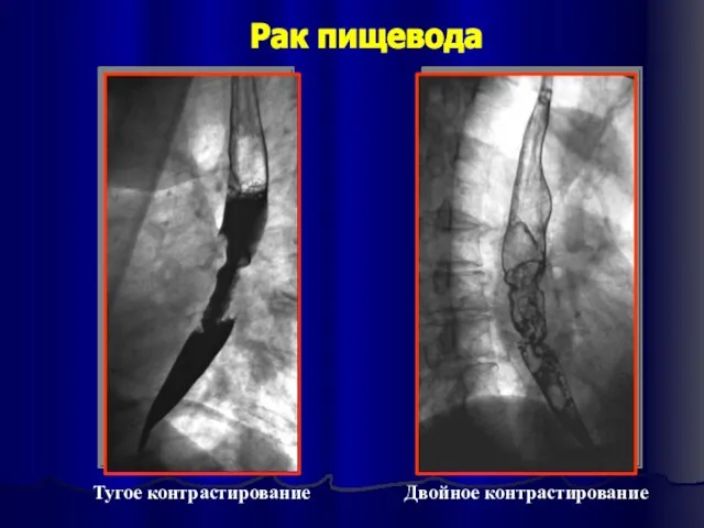 Рак пищевода Тугое контрастирование Двойное контрастирование