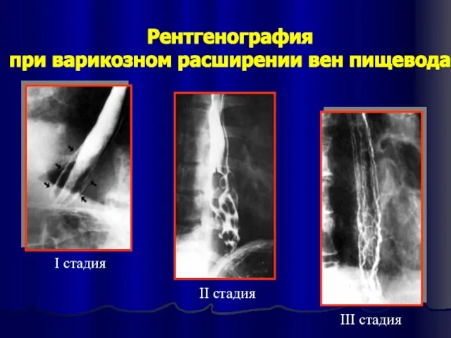 Рентгенография при варикозном расширении вен пищевода I стадия II стадия III стадия