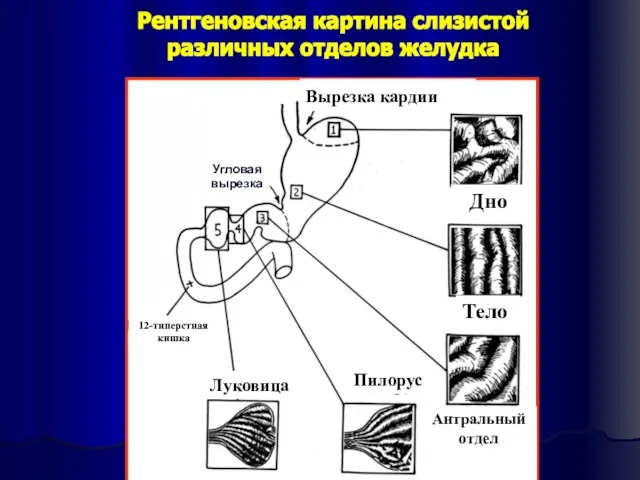 Рентгеновская картина слизистой различных отделов желудка