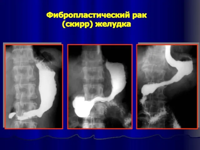 Фибропластический рак (скирр) желудка