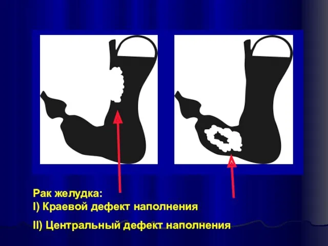 Рак желудка: I) Краевой дефект наполнения II) Центральный дефект наполнения