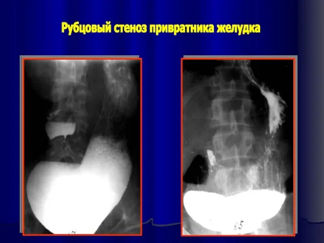 Рубцовый стеноз привратника желудка