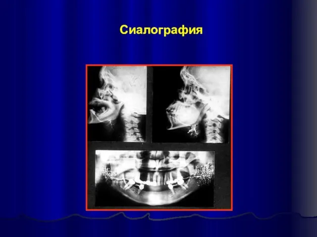 Сиалография