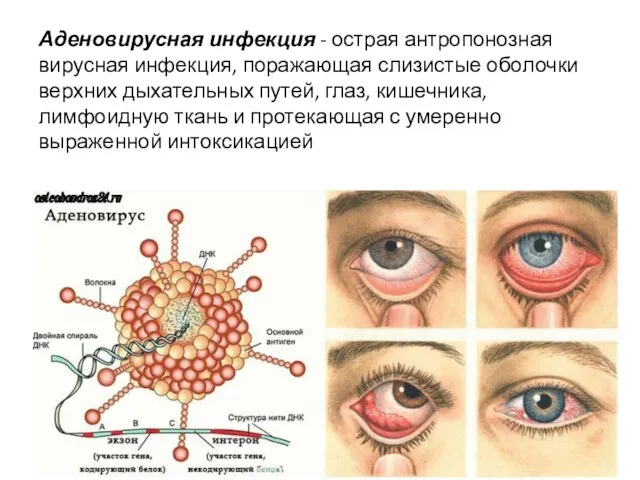 Аденовирусная инфекция - острая антропонозная вирусная инфекция, поражающая слизистые оболочки