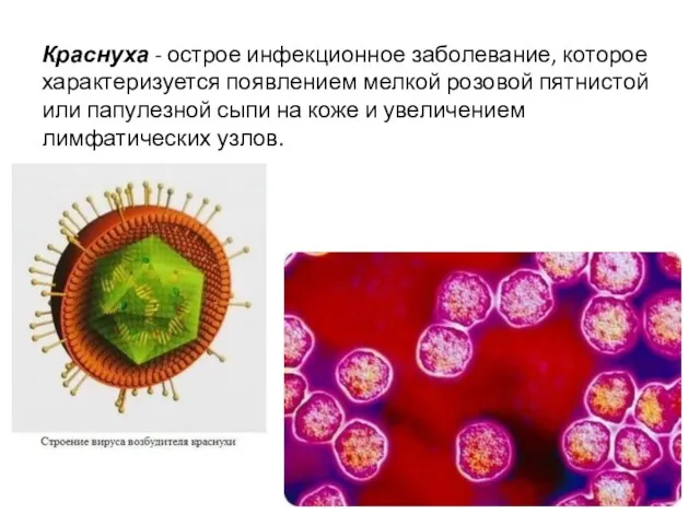 Краснуха - острое инфекционное заболевание, которое характеризуется появлением мелкой розовой