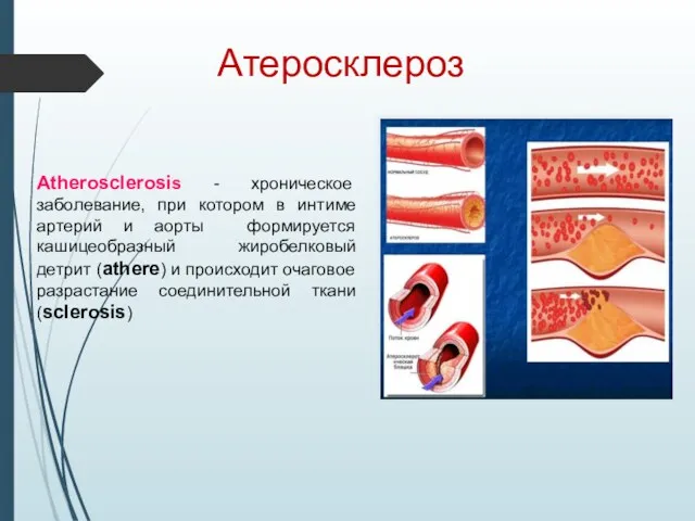 Атеросклероз Atherosclerosis - хроническое заболевание, при котором в интиме артерий