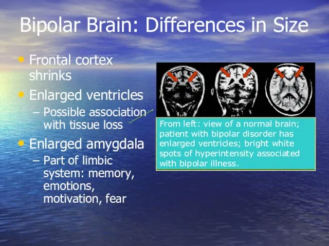 Bipolar Brain: Differences in Size Frontal cortex shrinks Enlarged ventricles