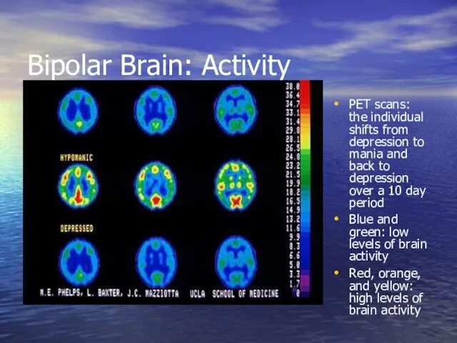 Bipolar Brain: Activity PET scans: the individual shifts from depression