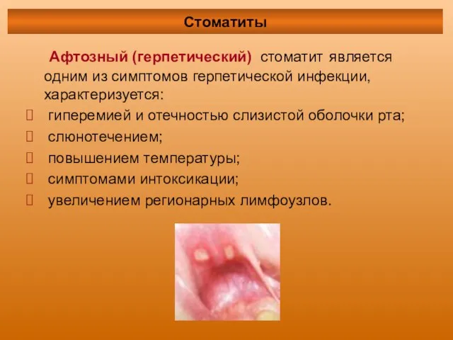 Афтозный (герпетический) стоматит является одним из симптомов герпетической инфекции, характеризуется: гиперемией и отечностью