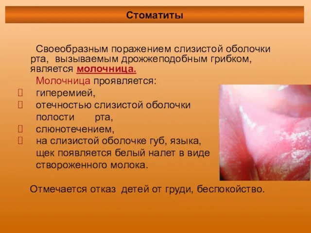Своеобразным поражением слизистой оболочки рта, вызываемым дрожжеподобным грибком, является молочница. Молочница проявляется: гиперемией,