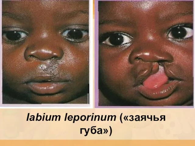 labium leporinum («заячья губа»)