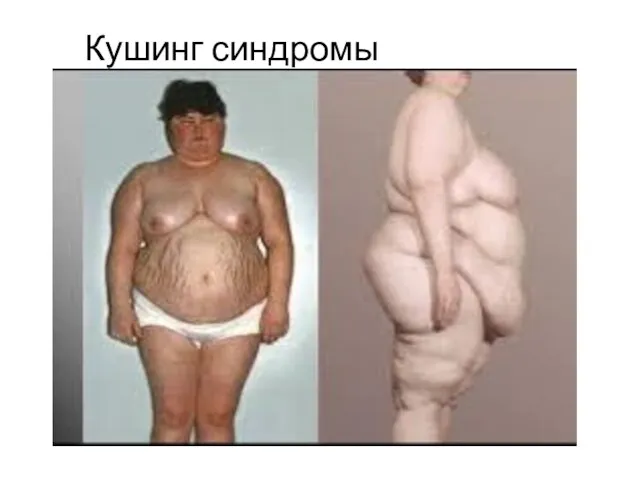 Кушинг синдромы