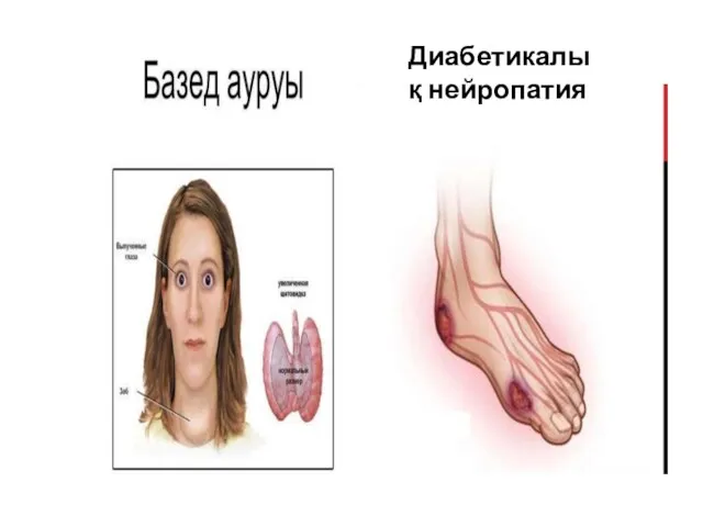 Диабетикалық нейропатия