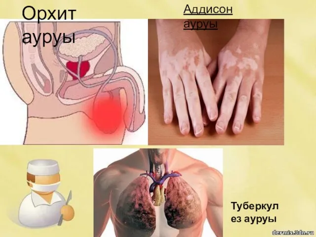 Орхит ауруы Аддисон ауруы Туберкулез ауруы