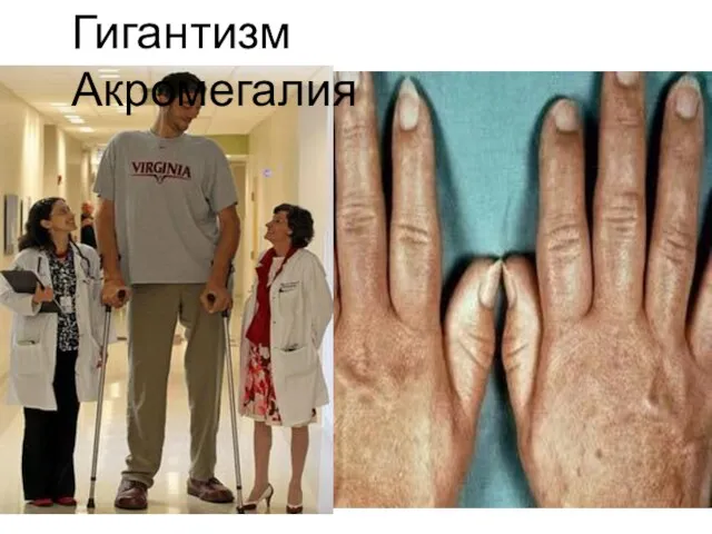 Гигантизм Акромегалия