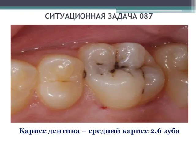 СИТУАЦИОННАЯ ЗАДАЧА 087 Кариес дентина – средний кариес 2.6 зуба