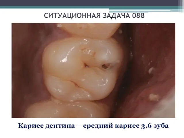 СИТУАЦИОННАЯ ЗАДАЧА 088 Кариес дентина – средний кариес 3.6 зуба