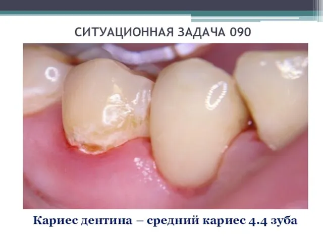 СИТУАЦИОННАЯ ЗАДАЧА 090 Кариес дентина – средний кариес 4.4 зуба