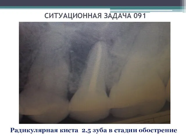 СИТУАЦИОННАЯ ЗАДАЧА 091 Радикулярная киста 2.5 зуба в стадии обострение